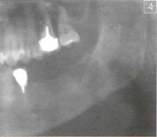 Остеоматрикс при хирургическом лечении радикулярных кист челюстей