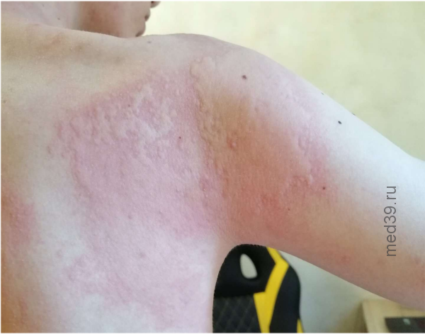 Волдыри на теле