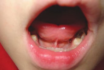 коклюш фото