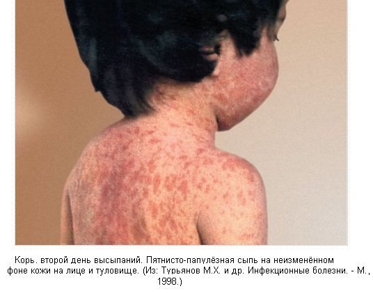Корь у ребенка фото