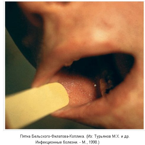 Корь, пятна Бельского-Филатова-Коплика