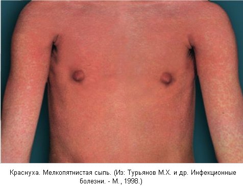 Краснуха фото