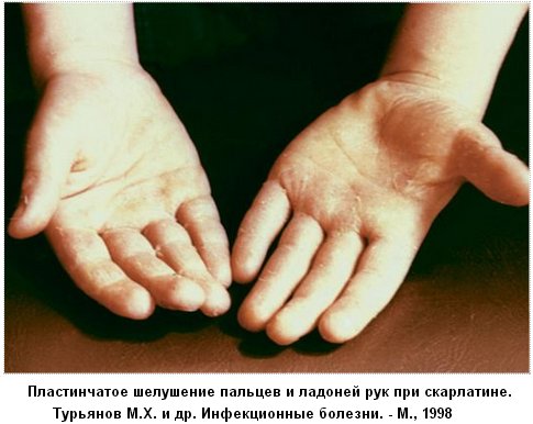 скарлатина фото