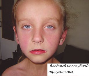 скарлатина фото