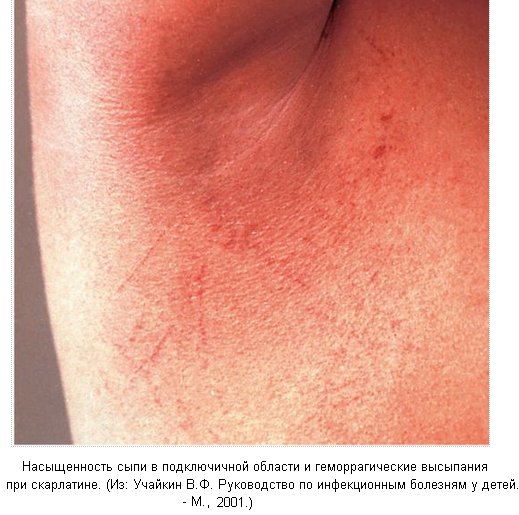 скарлатина