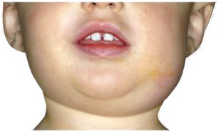 паротит, свинка фото