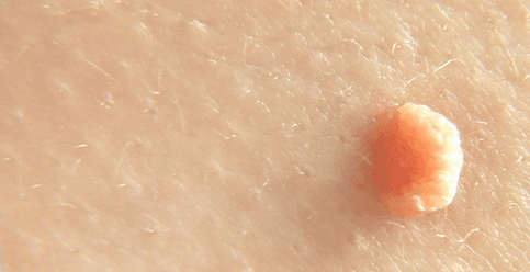 вирус папилломы человека