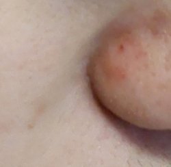 Лекарственные растения для лечения акне