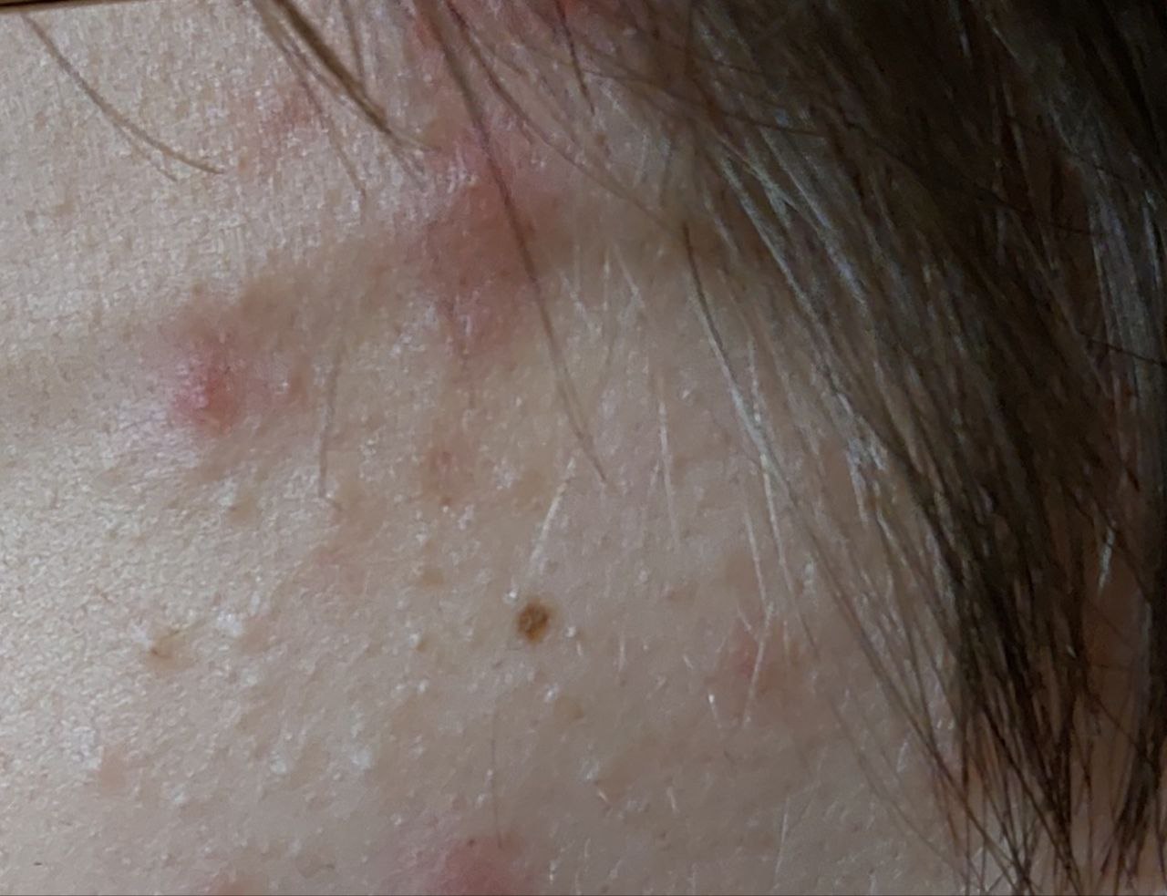 средства лечения акне