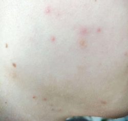 Проблемная кожа