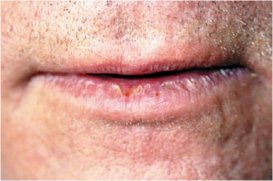 Актинический хейлит, шелушатся губы