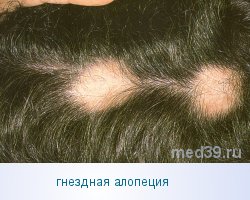 алопеция, облысение