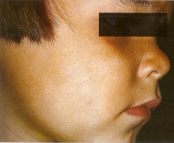 белый лишай