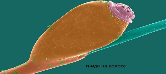 Гнида на волосе