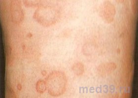 Крапивница