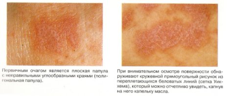 Красный плоский лишай