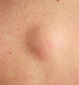 Что такое липома и насколько она опасна?