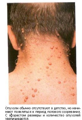 нейрофиброматоз