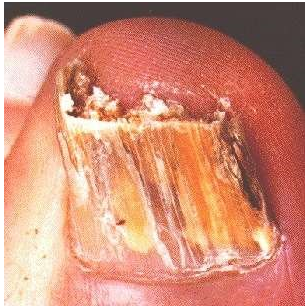 Дистальный и боковой онихомикоз