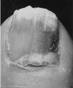 Проксимальный  онихомикоз