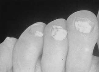 Белый поверхностный онихомикоз