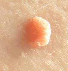 Как правильно готовиться к анализам на ВПЧ и что они означают