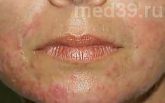 лечение прыщей