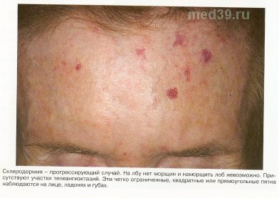склеродермия фото