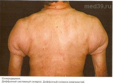 склеродермия фото