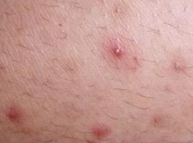 волосяной фолликул