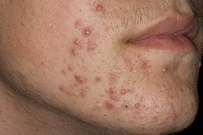 угревая сыпь