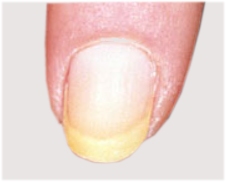 Желтые ногти
