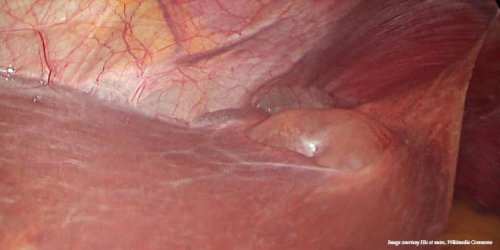 Киста печени