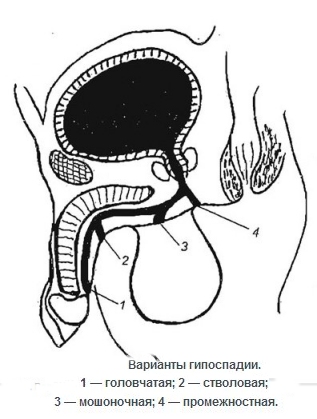 Гипоспадия