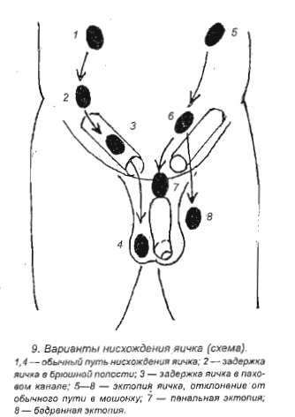 Неправильное расположение яичек