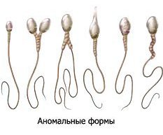 Плохие сперматозоиды