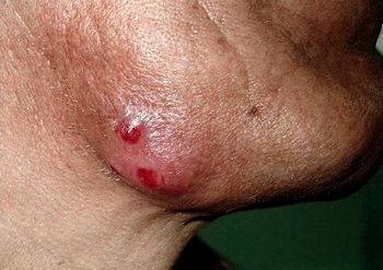 Актиномикоз