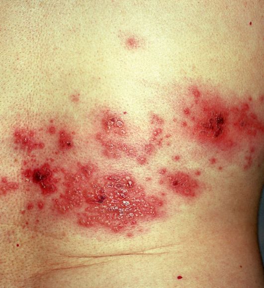 опоясывающий лишай