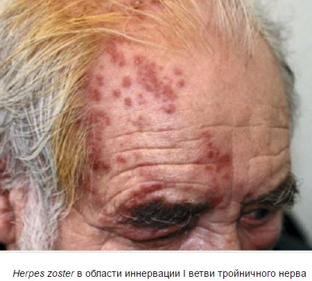 опоясывающий лишай на голове