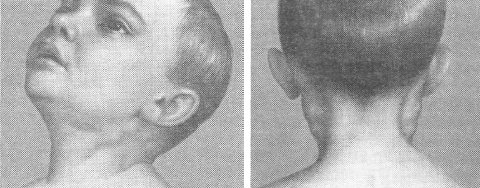 мононуклеоз