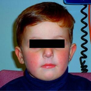 Парвовирусная инфекция