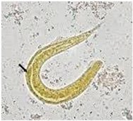 Стронгилоидоз