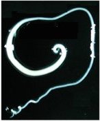 Трихоцефалез лечение