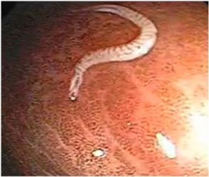 Трихоцефалез