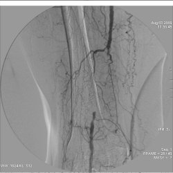 Атеросклероз сосудов нижних конечностей