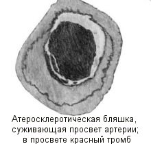 атеросклероз