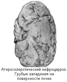 атеросклероз