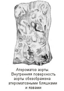 атеросклероз