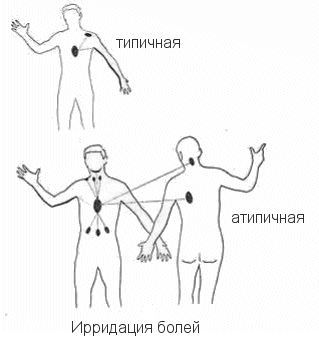 Боль при стенокардии