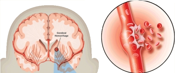 Что такое геморрагический  инсульт